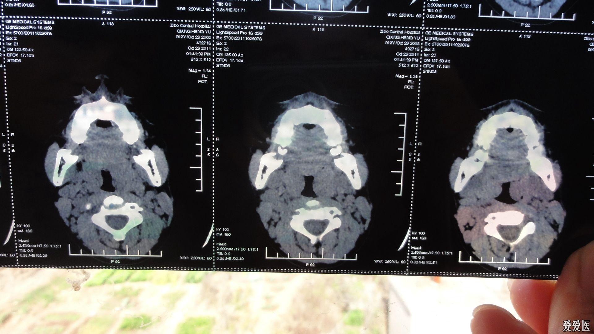 内科大夫求助增殖体肥大