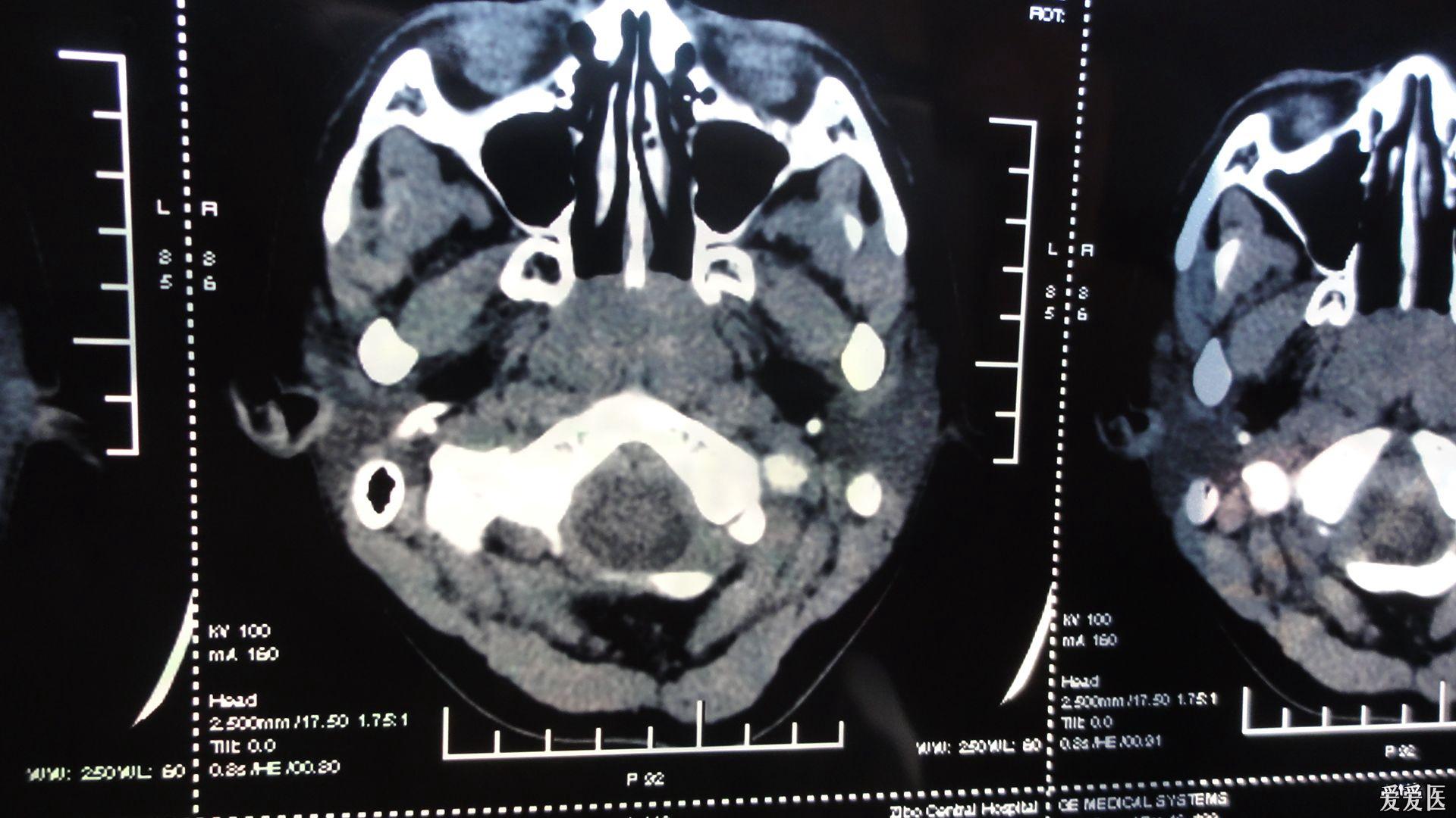 内科大夫求助增殖体肥大