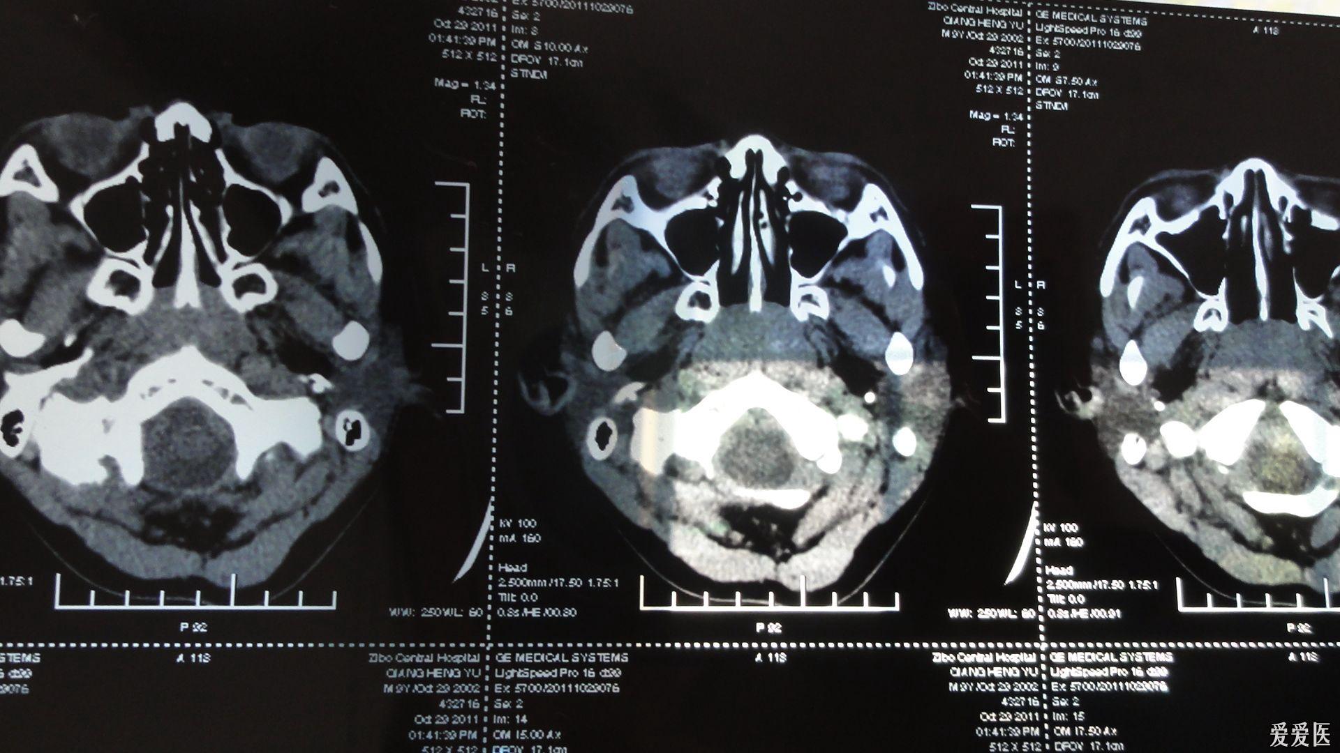 内科大夫求助增殖体肥大