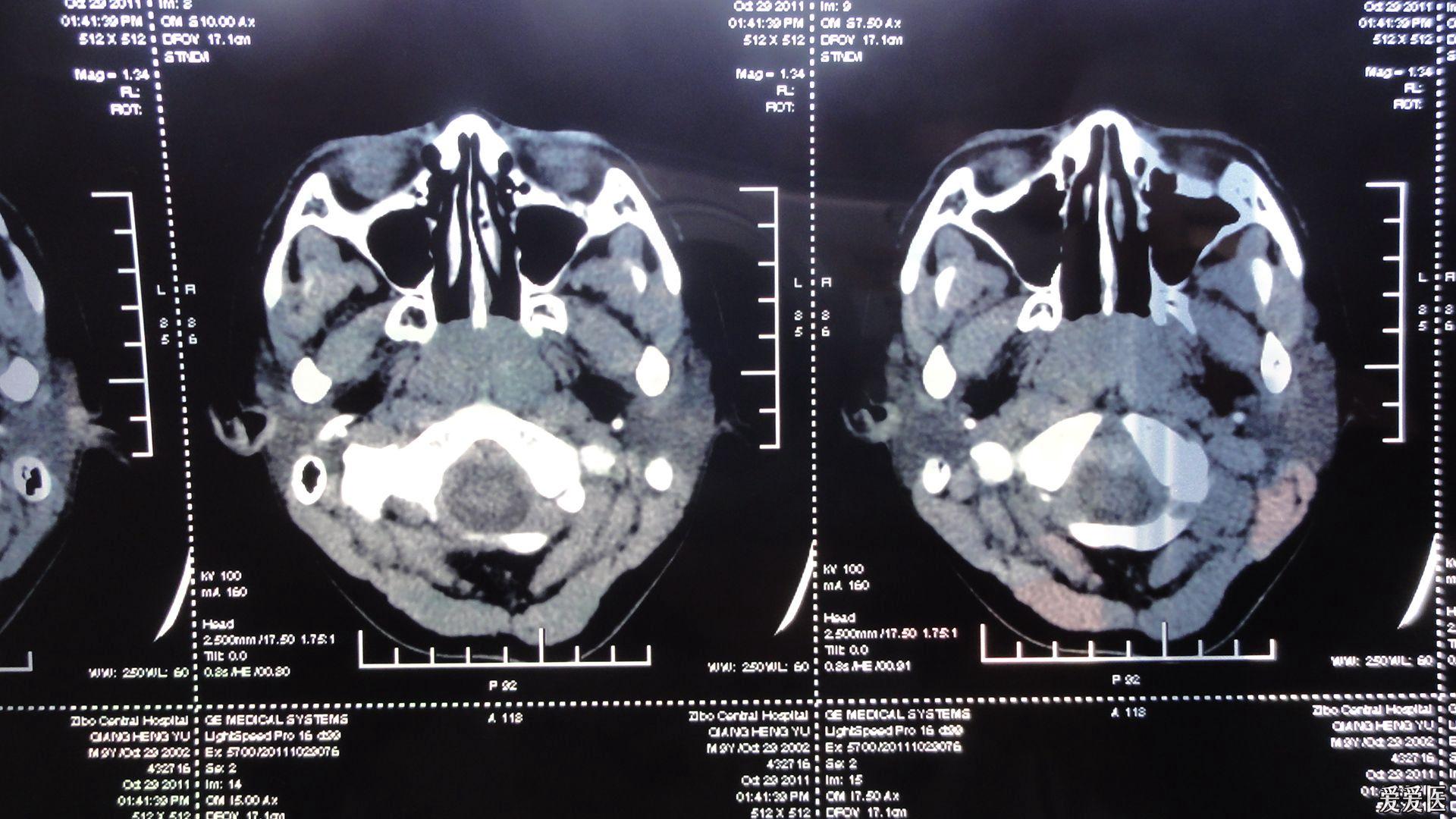 内科大夫求助增殖体肥大
