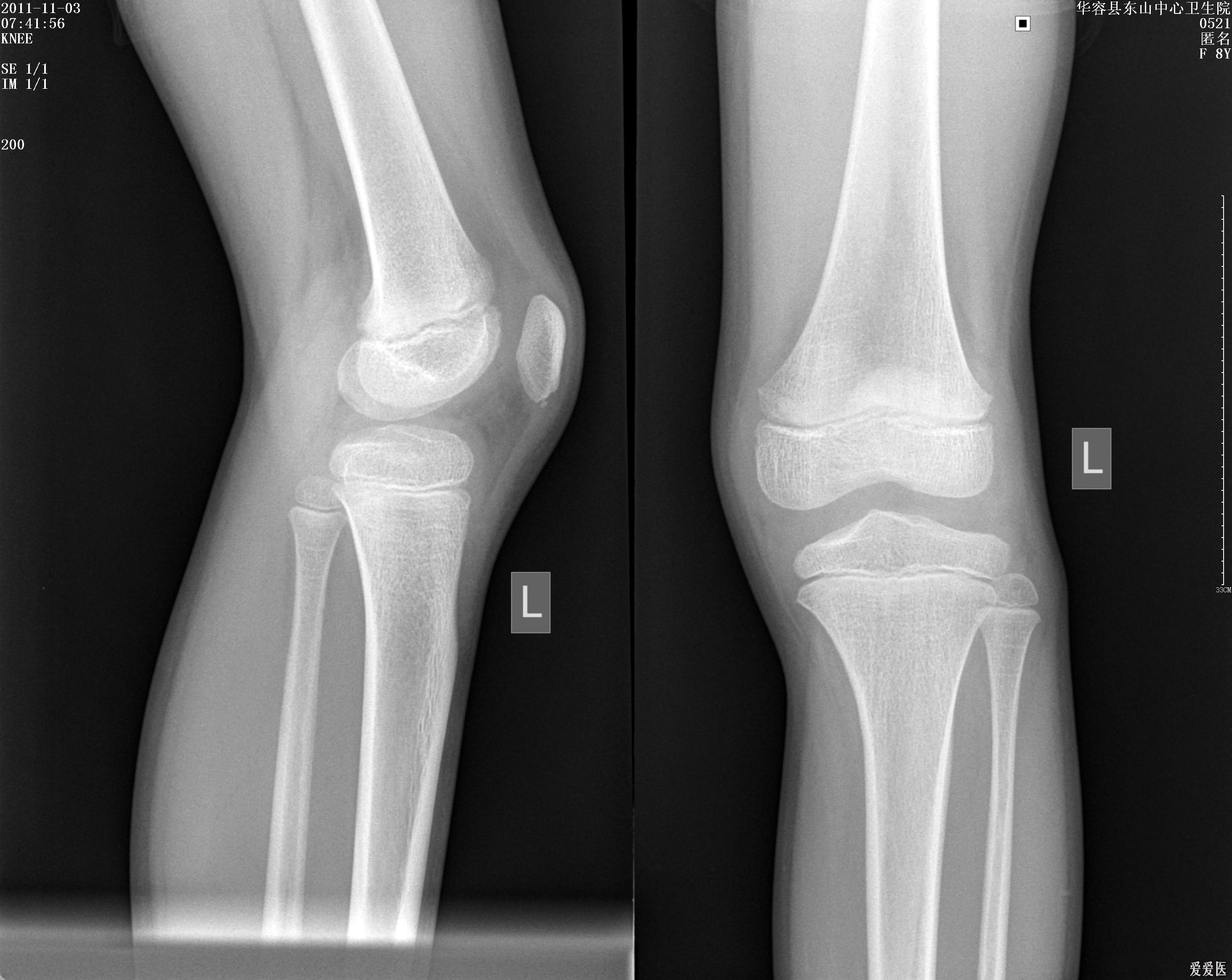 正常膝关节x线图片图片