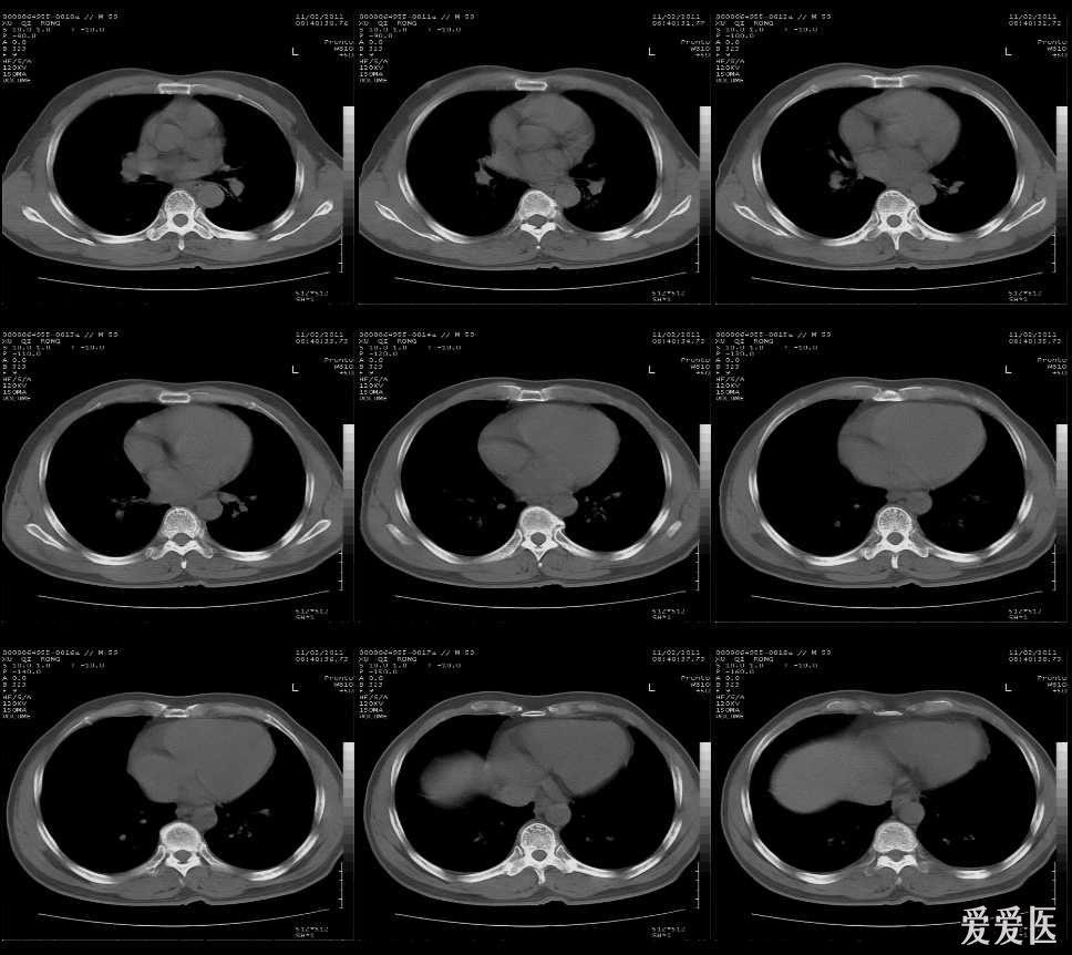 胸部ct讀片 - 醫學影像學討論版 - 愛愛醫醫學論壇