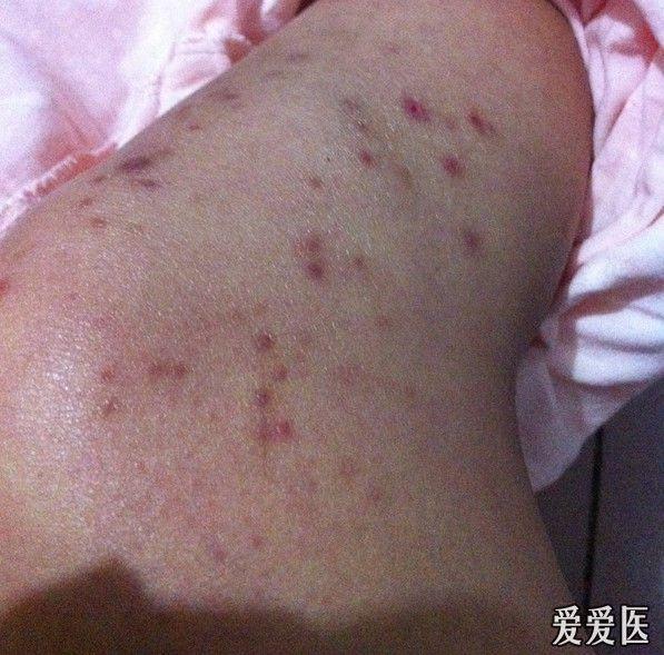 求助过敏还是真菌感染有图