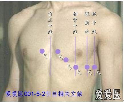 看图学心电01左右手反接与镜像右位心 心电图培训版 爱爱医医学论坛