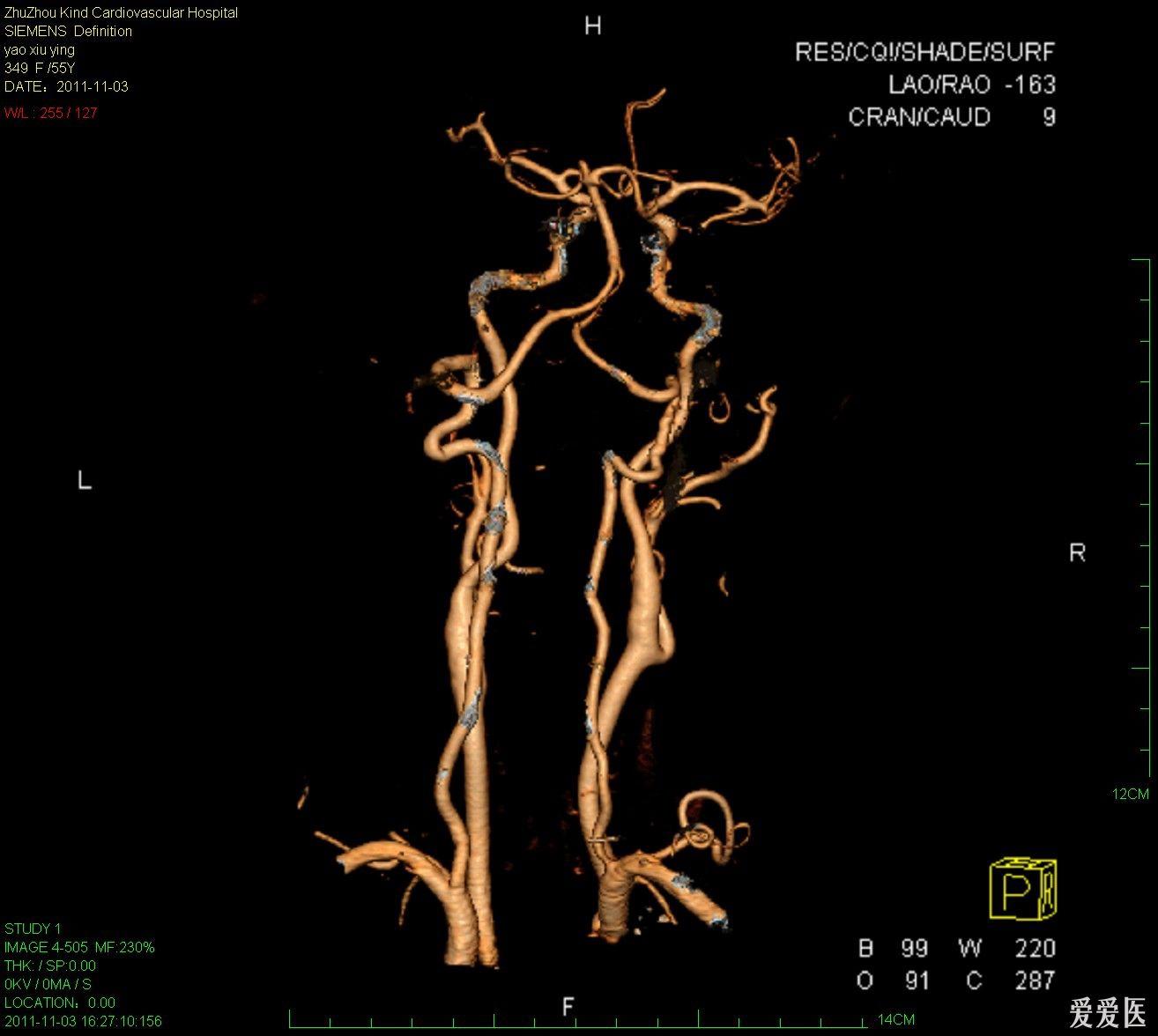 双源ct头部血管cta 医学影像学讨论版 爱爱医医学论坛