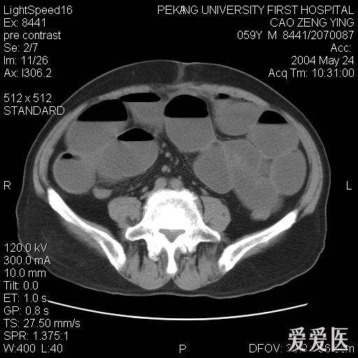 腸梗阻ct圖片鑑賞