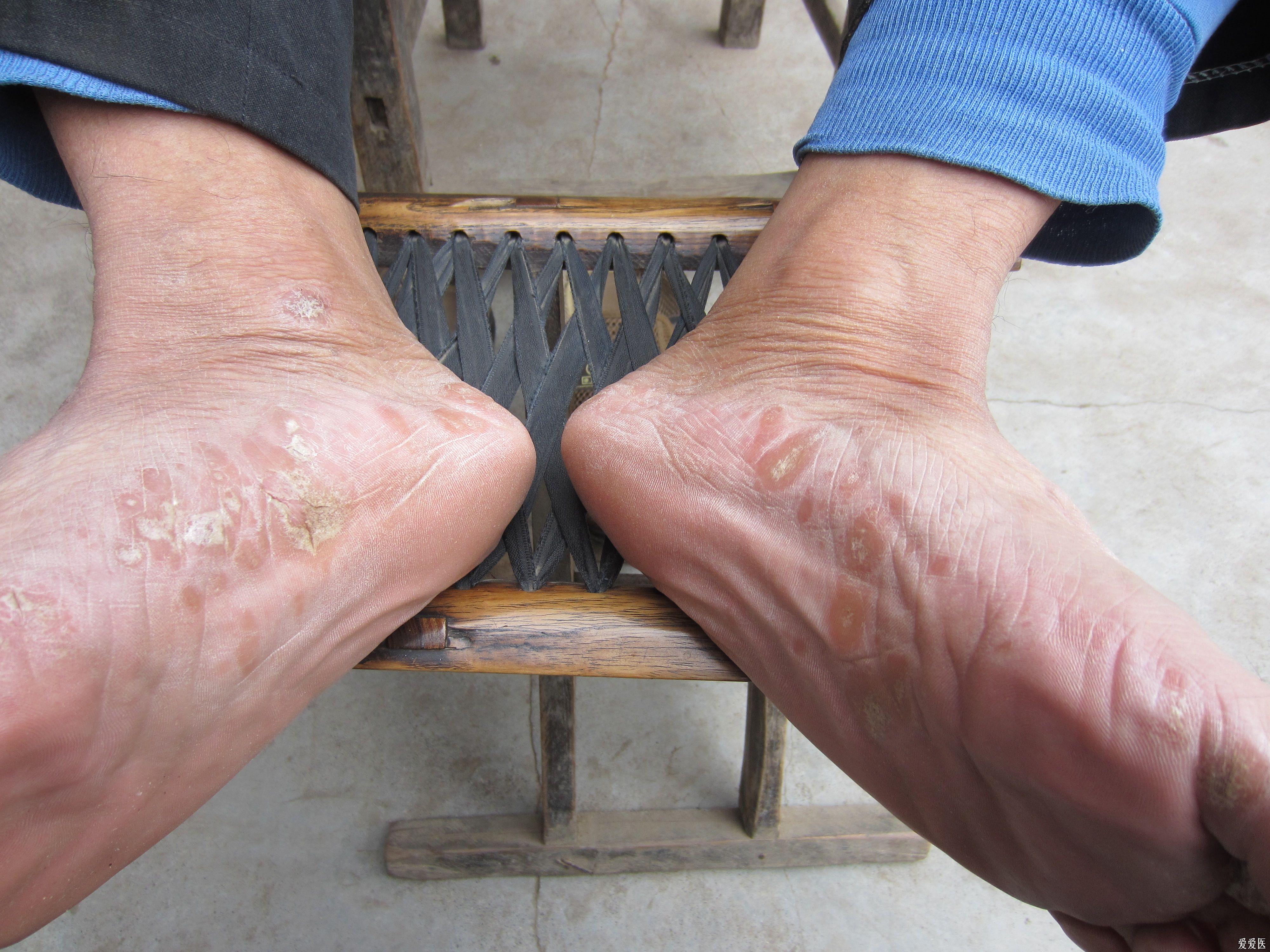 双手足红斑脱屑瘙痒