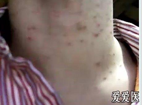 脖子上的红疹