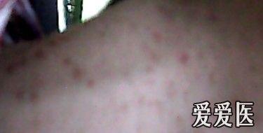 脖子上的红疹