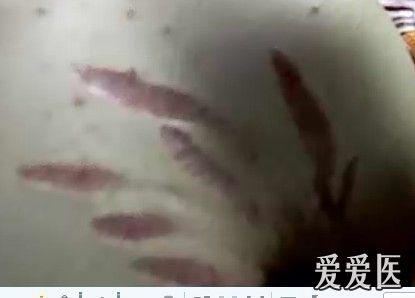 腋窝附近的萎缩纹？？