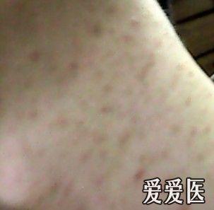 脖子上的红疹