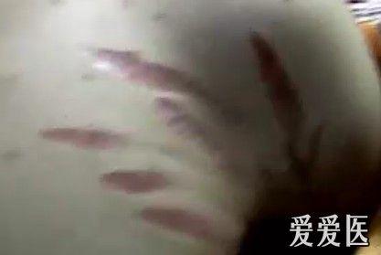 腋窝附近的萎缩纹？？