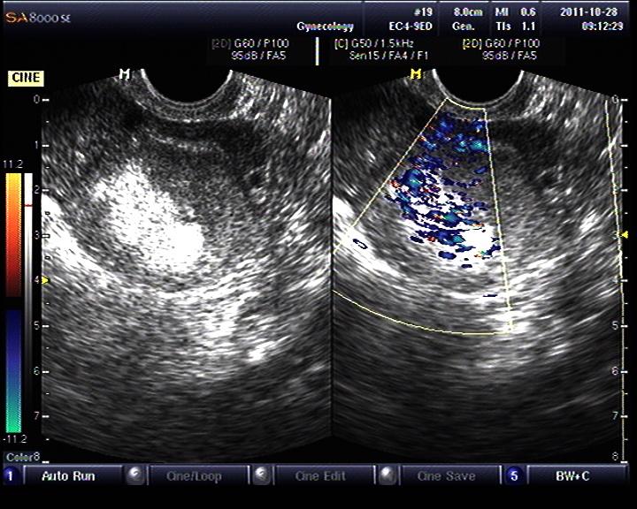 畸胎瘤的超声图像图片