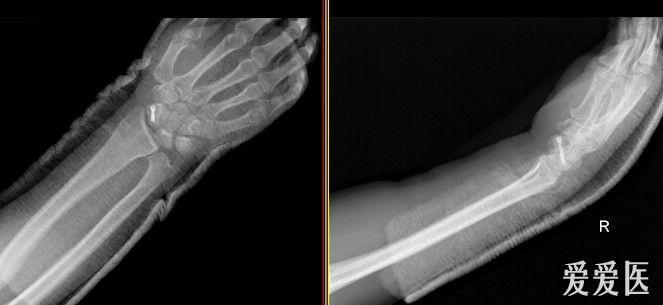 右手舟状骨骨折 骨科与显微外科专业讨论版 爱爱医医学论坛