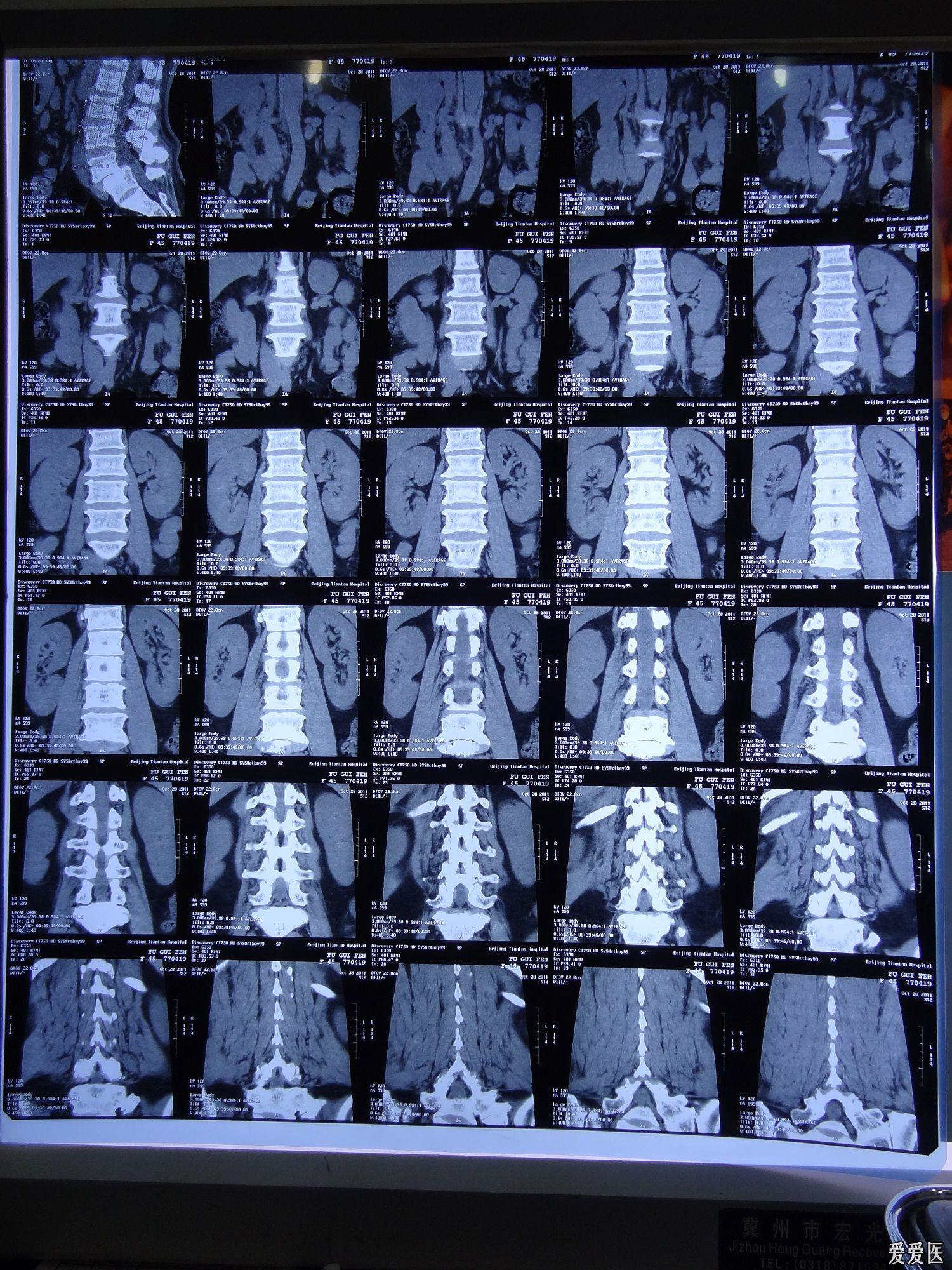 一例快要截瘫的腰椎滑脱, 二楼详细.患者又出新故障了,欢迎围观,指导!
