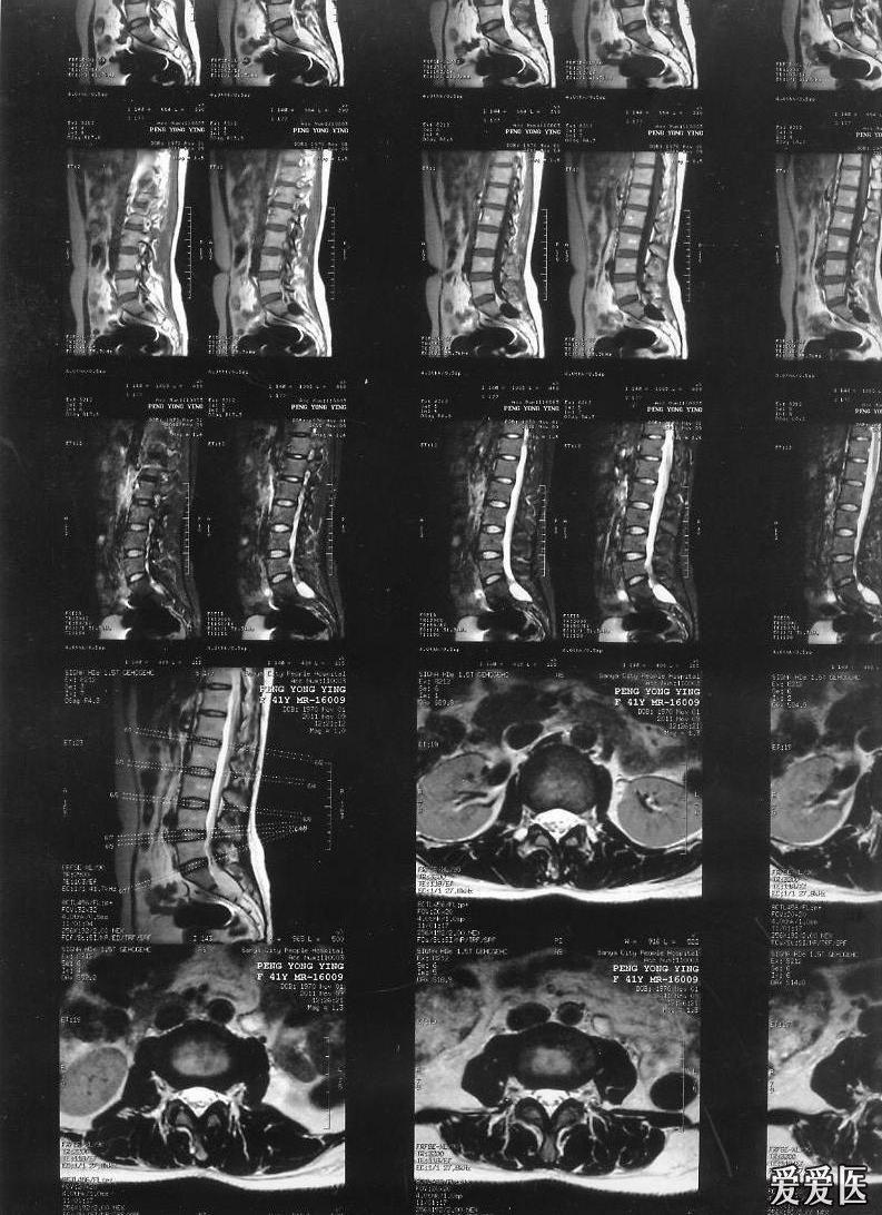 腰椎骶管囊肿图片图片
