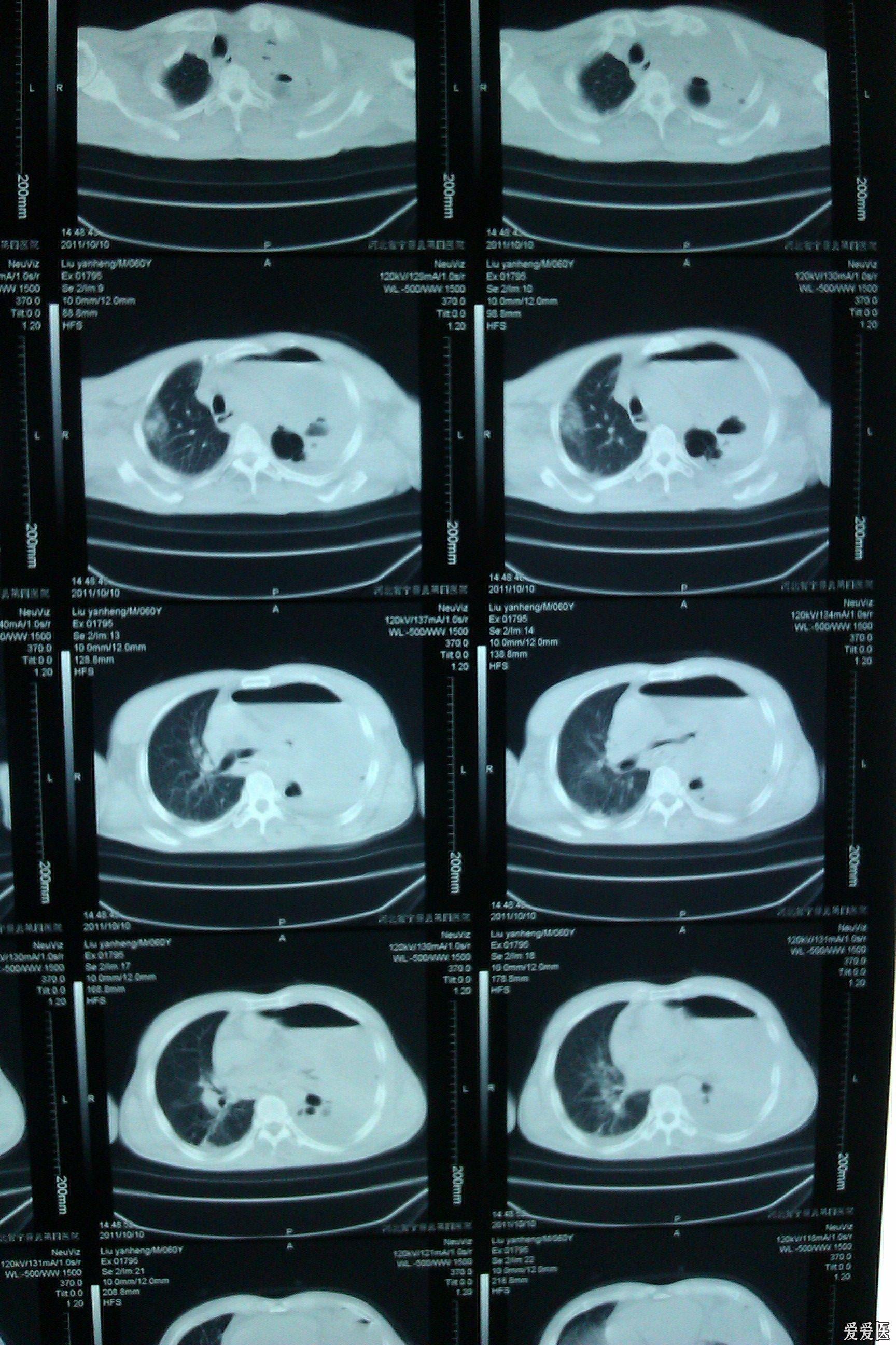 奇怪的食管癌术后胸腔影像学变化