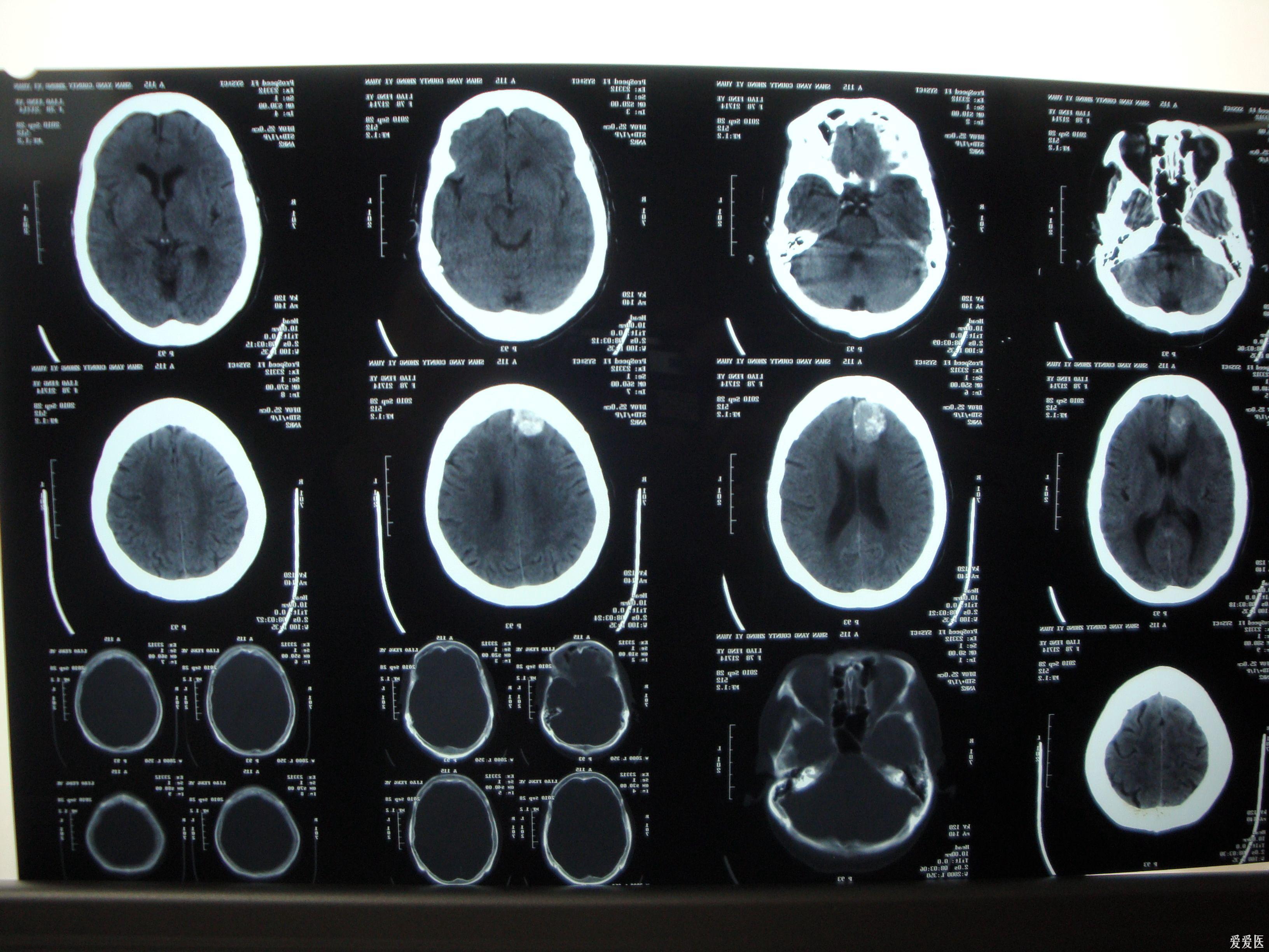 一例老年脑瘤病人术后现在恢复良好 - 神经外科专业讨论版 - 爱爱医医