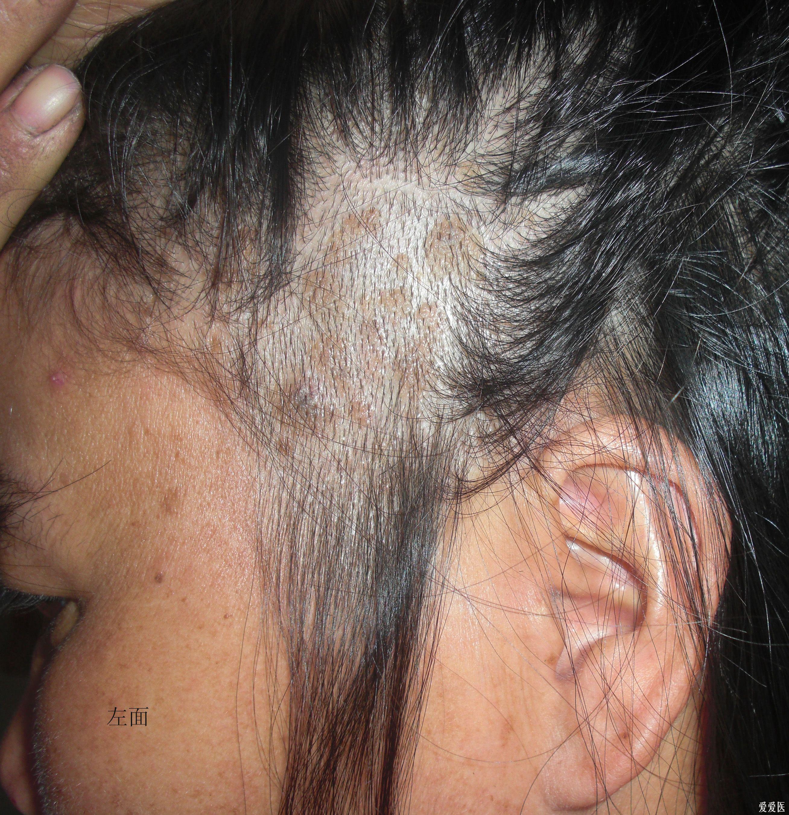 头部的皮肤病有图