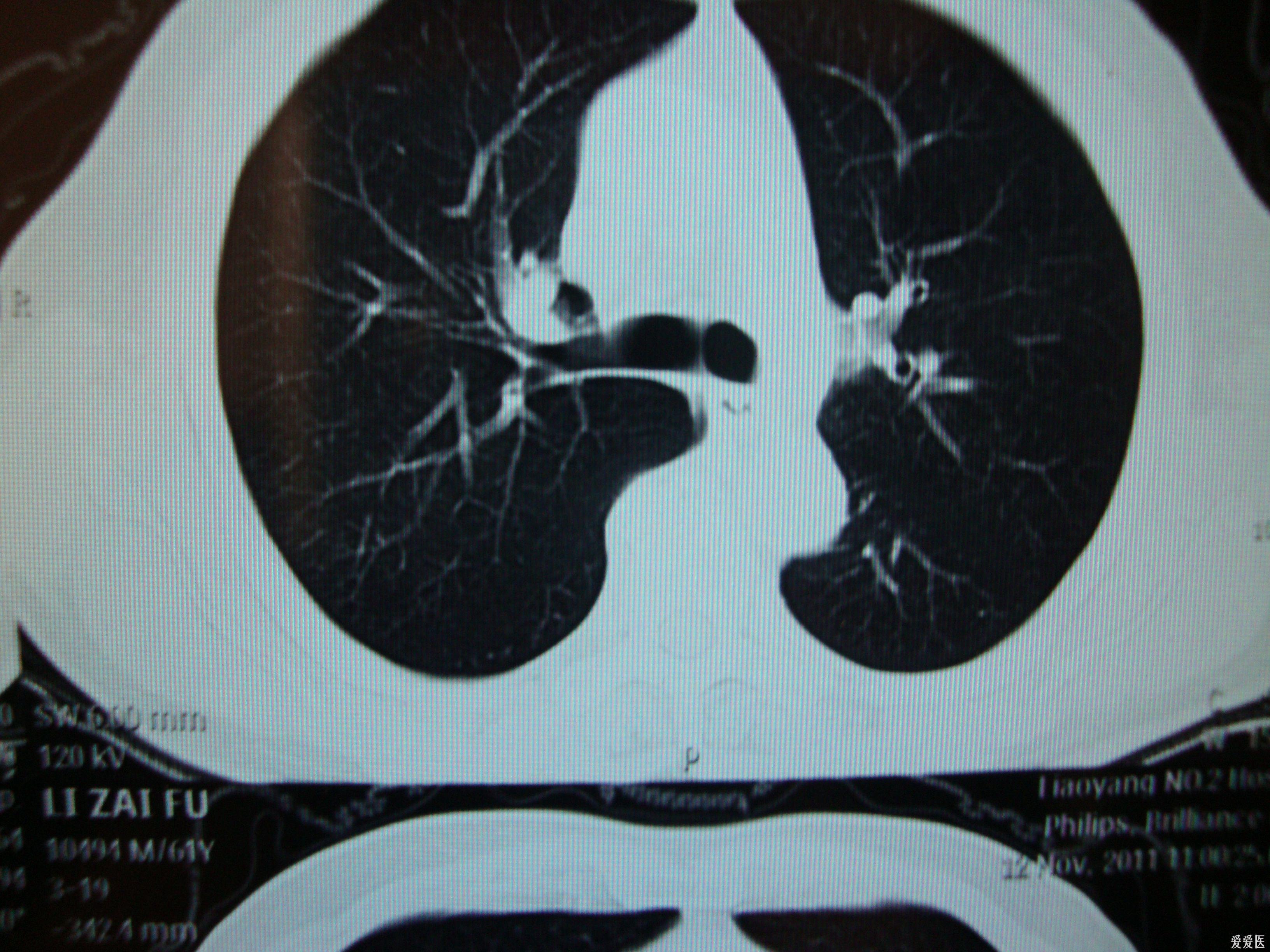 請各老師給看一看肺ct