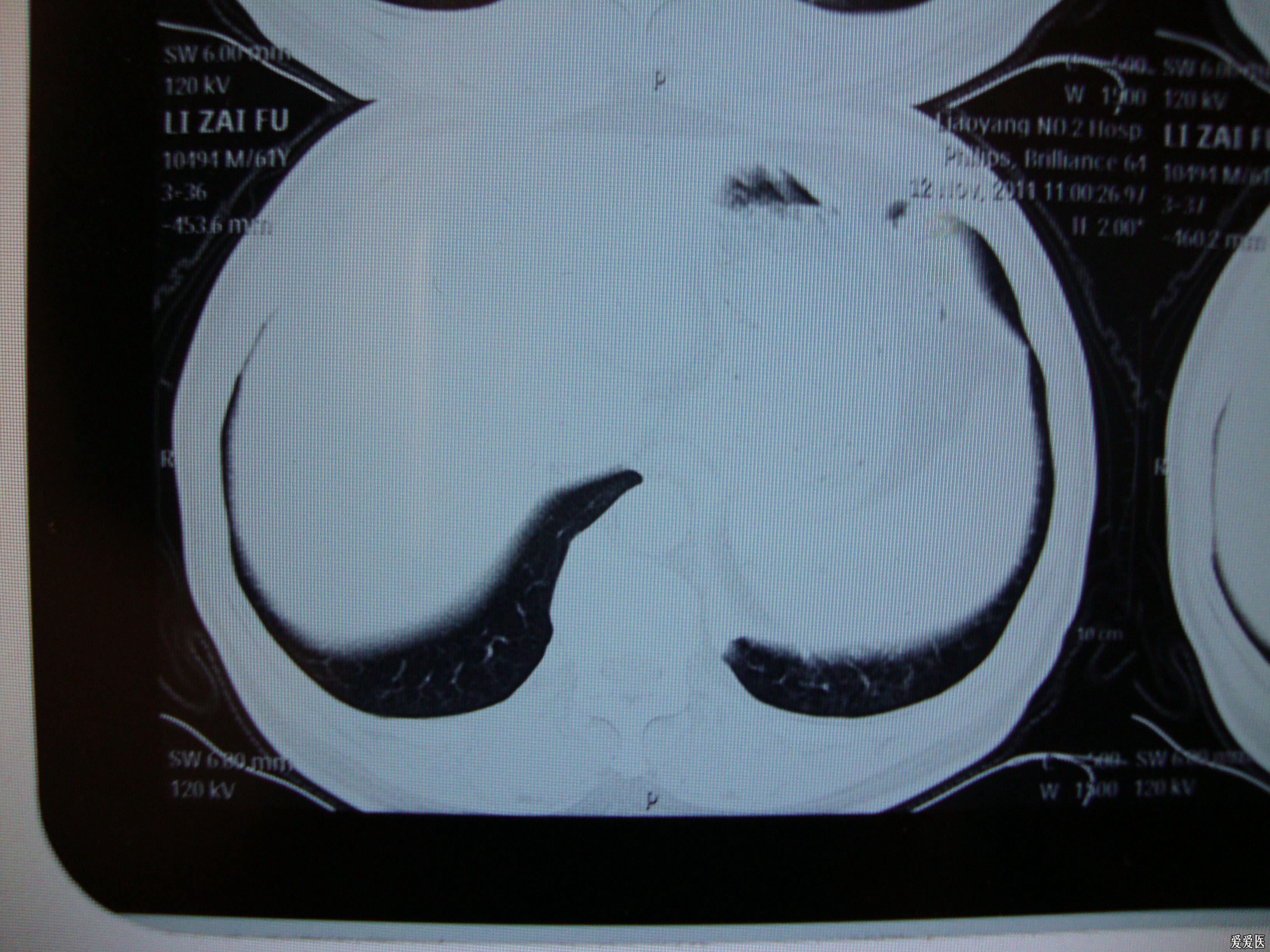 請各老師給看一看肺ct - 腫瘤醫學專業討論版 - 愛愛醫醫學論壇