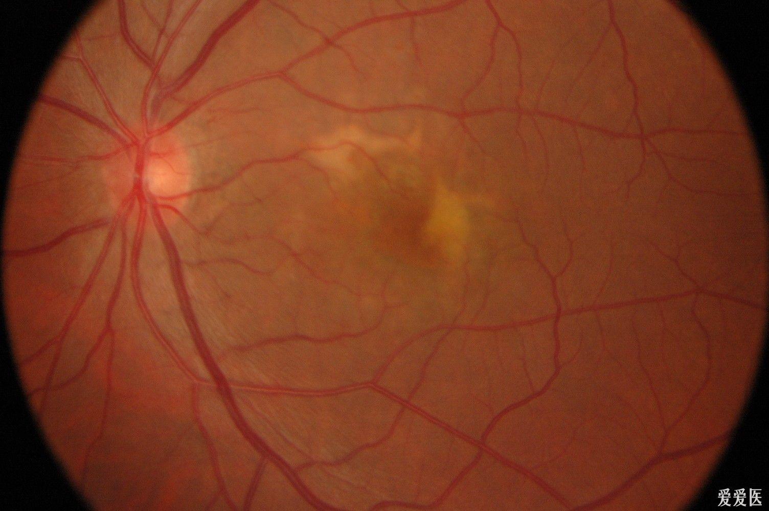 一些眼底图片和大家分享