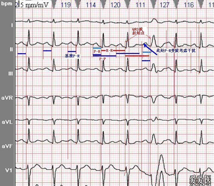 这幅图是室速还是室上速伴左束支型差传?