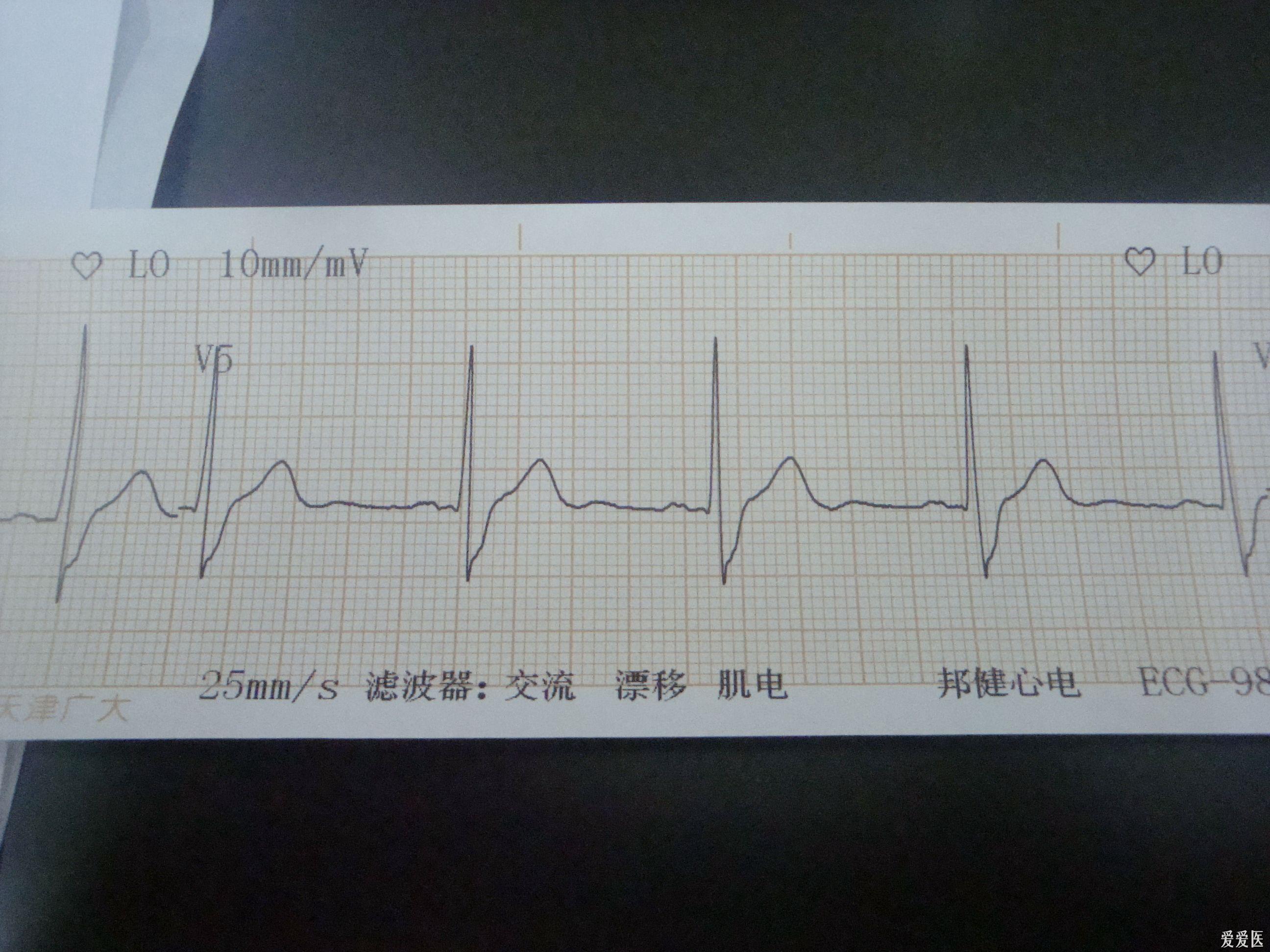 完右- 心电图脑电图专业讨论版 - 爱爱医医学论坛