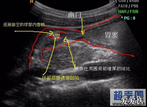 十二指腸球部潰瘍充盈到基本排空組圖