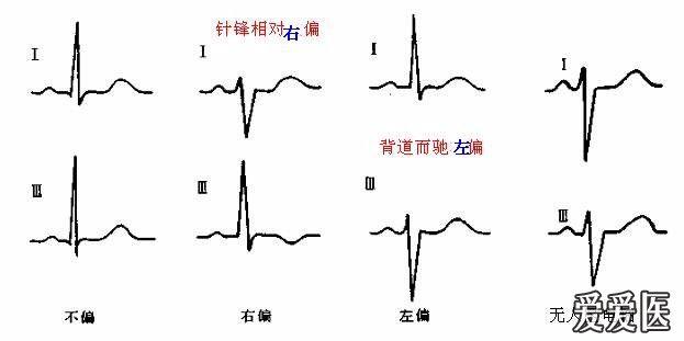 看图学心电02心电轴测量