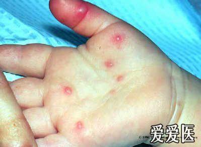 手足口病的图片症状及治疗