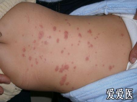 躯体红斑伴瘙痒丘疹性荨麻疹