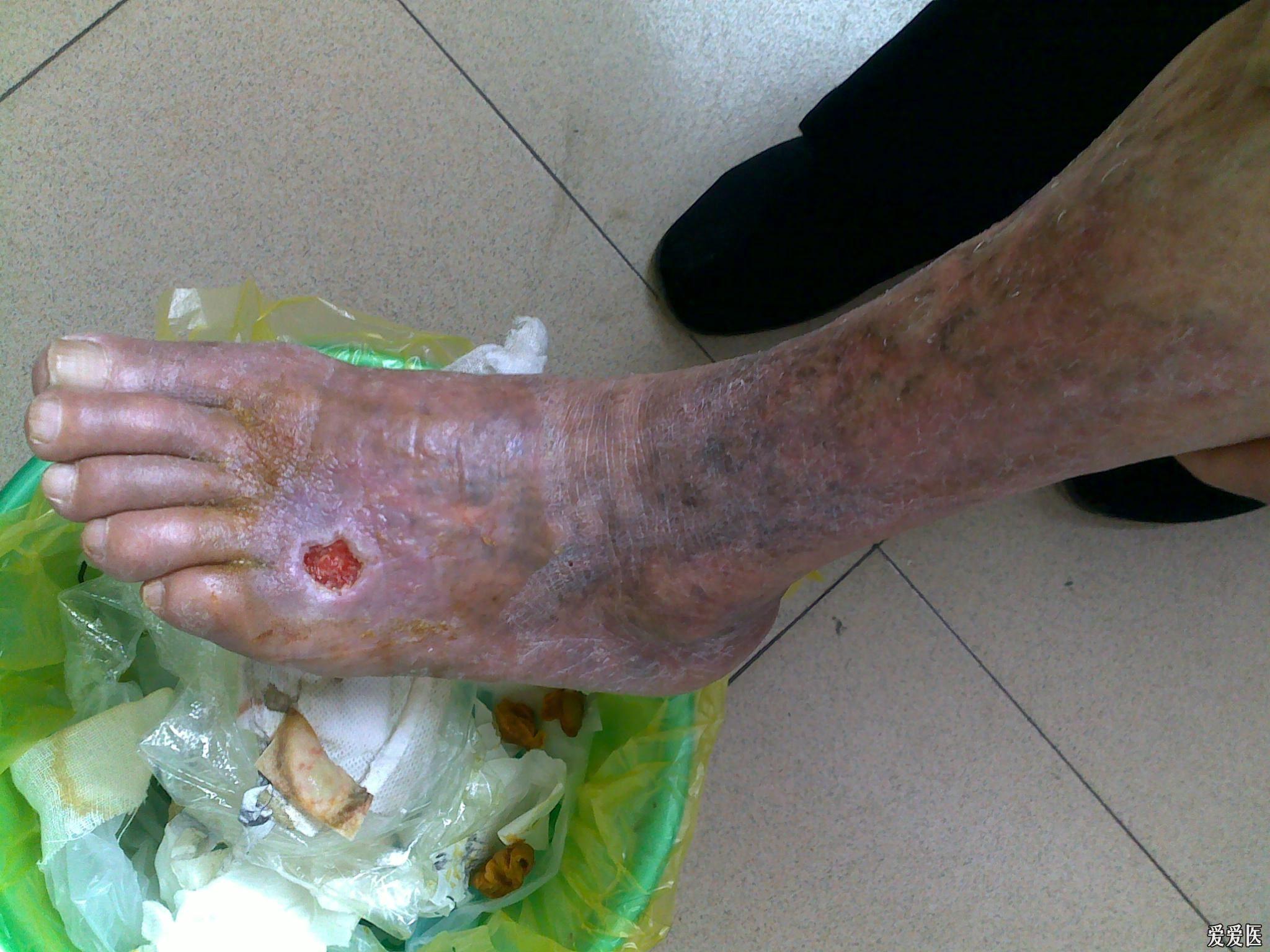 请帮我看看我的病人的下肢脚背皮肤溃烂的处理方法