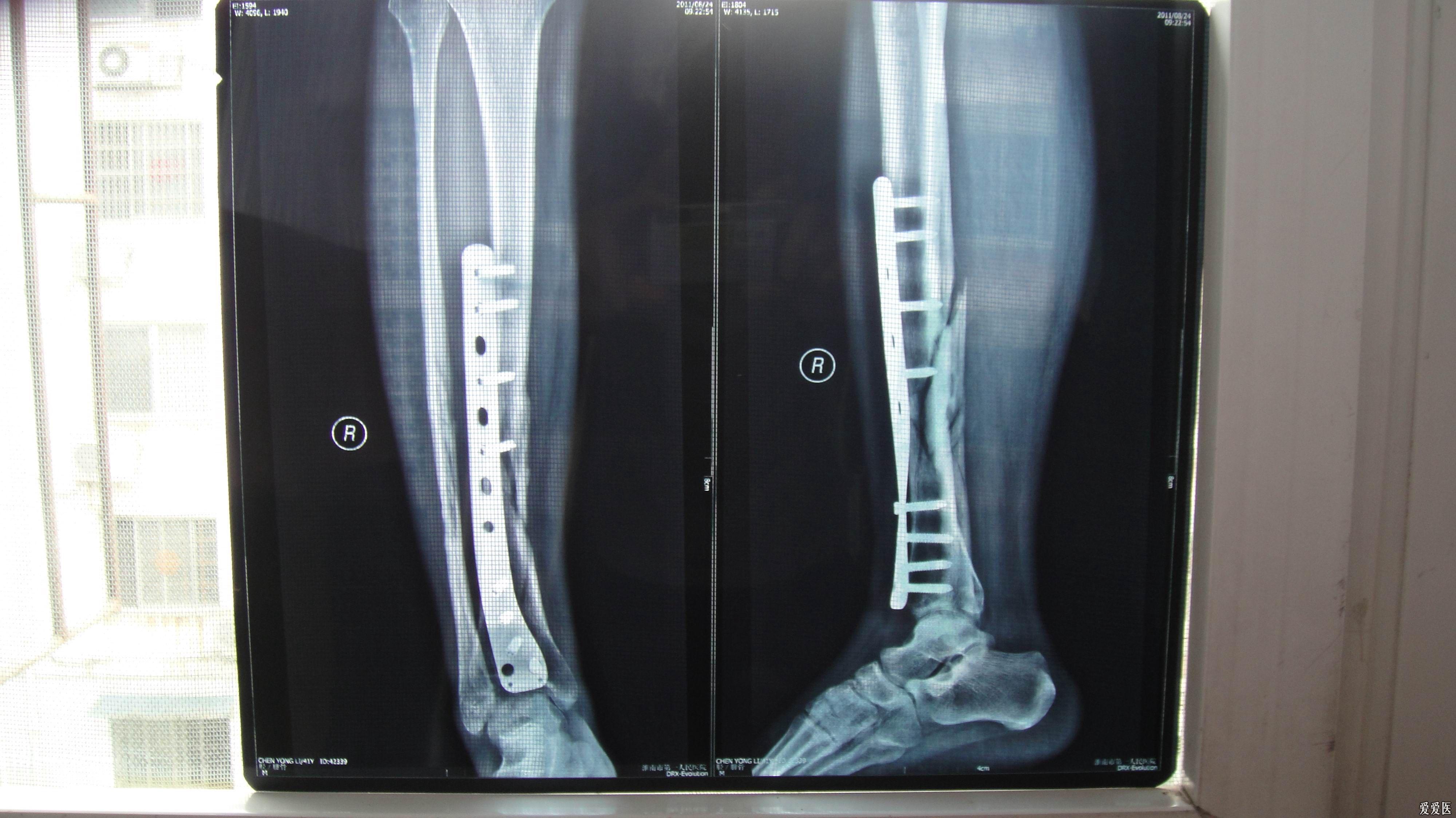 胫腓骨骨折术后照片图片