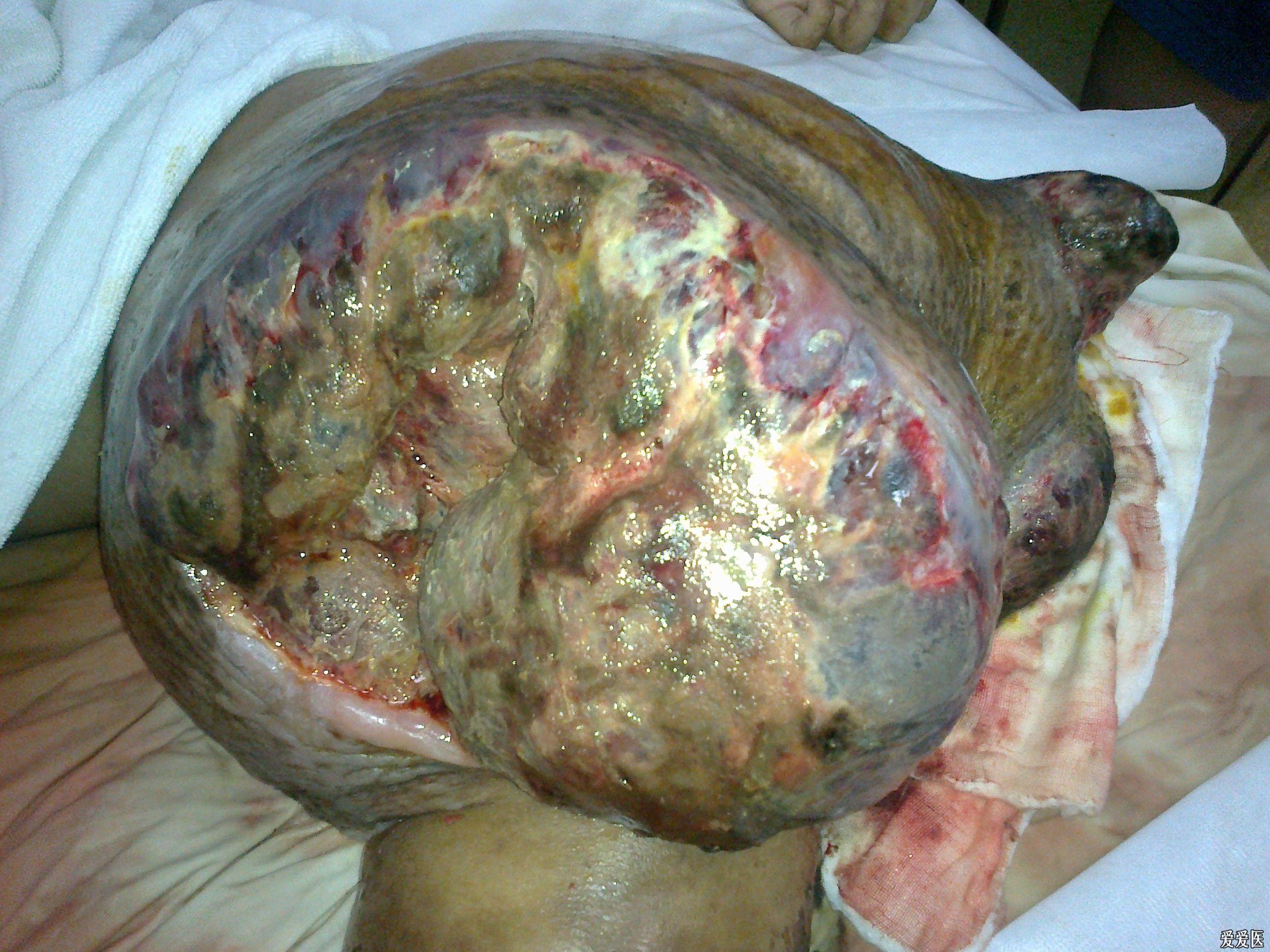 软骨肉瘤患者晚期图片图片