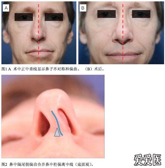 鼻中隔在弯鼻中的作用(摘译:zhjingqun)