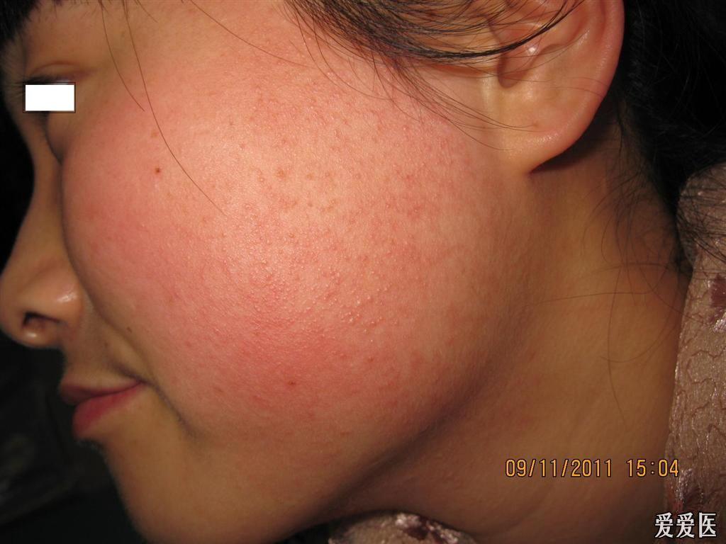 看图识病--------毛囊红斑黑变病