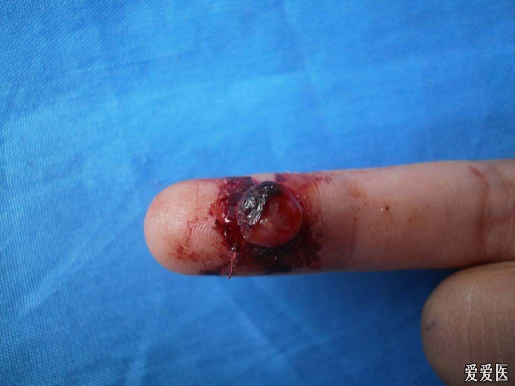 典型病例欣赏:化脓性肉芽肿(11.23).