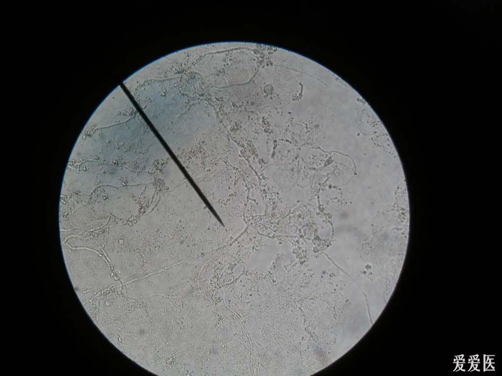 典型病例欣赏镜下真菌
