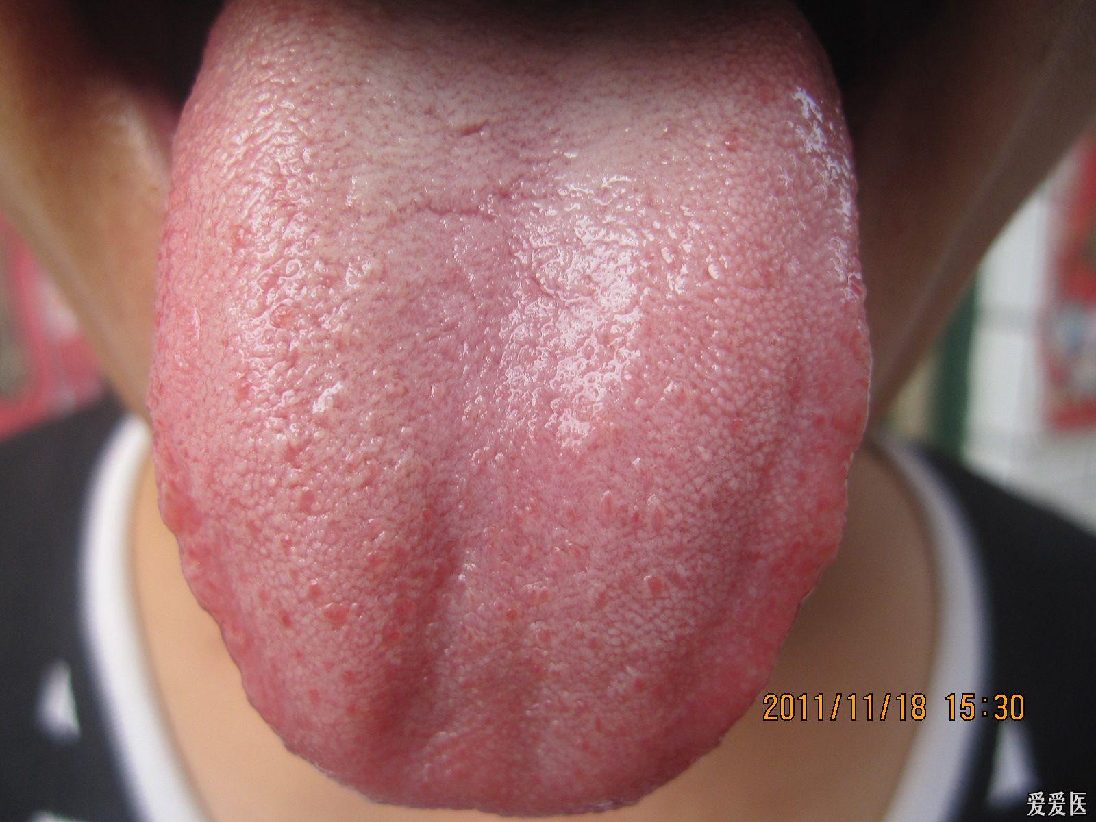 荨麻疹舌苔图片