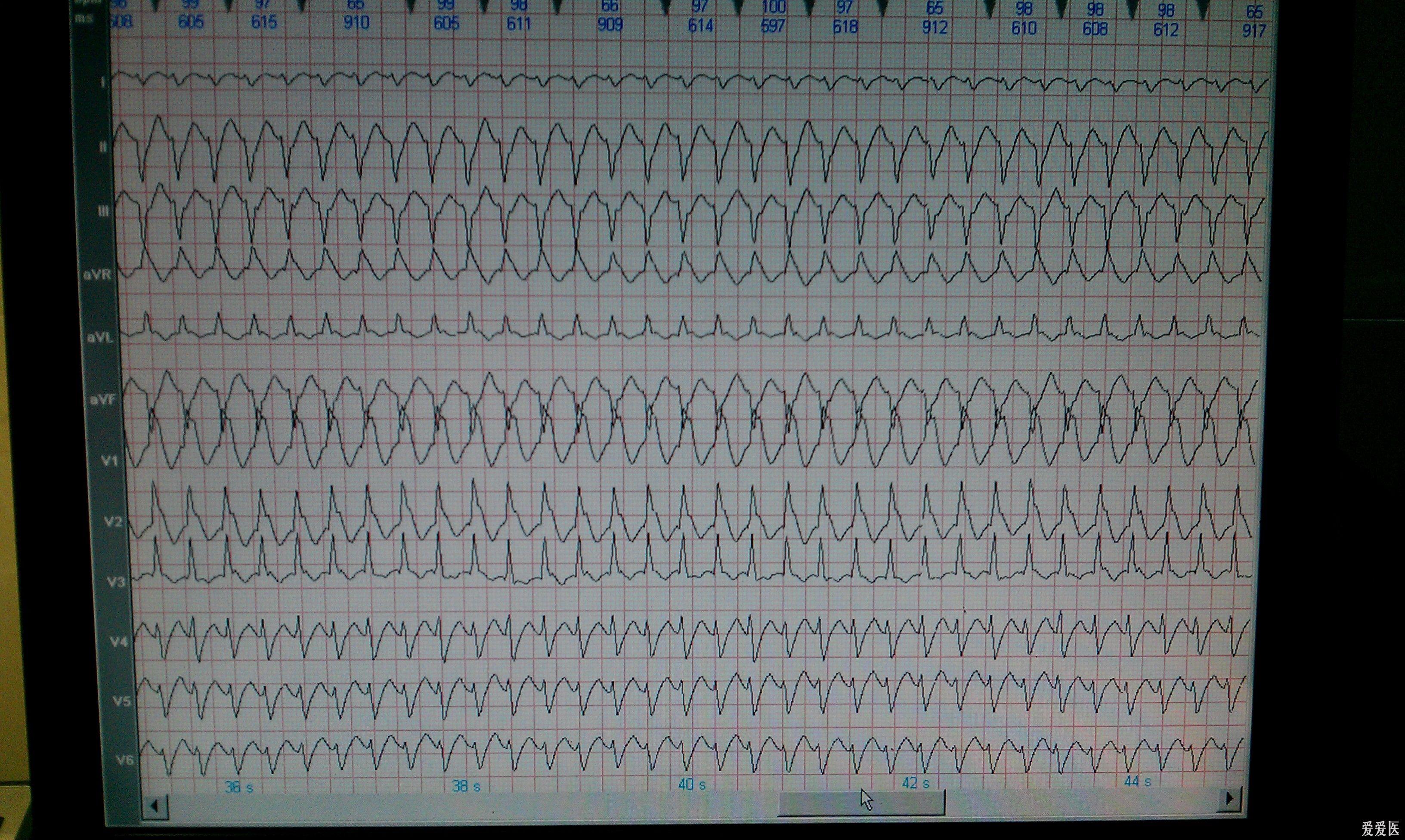 室速or室上速伴室差(附复查ecg)