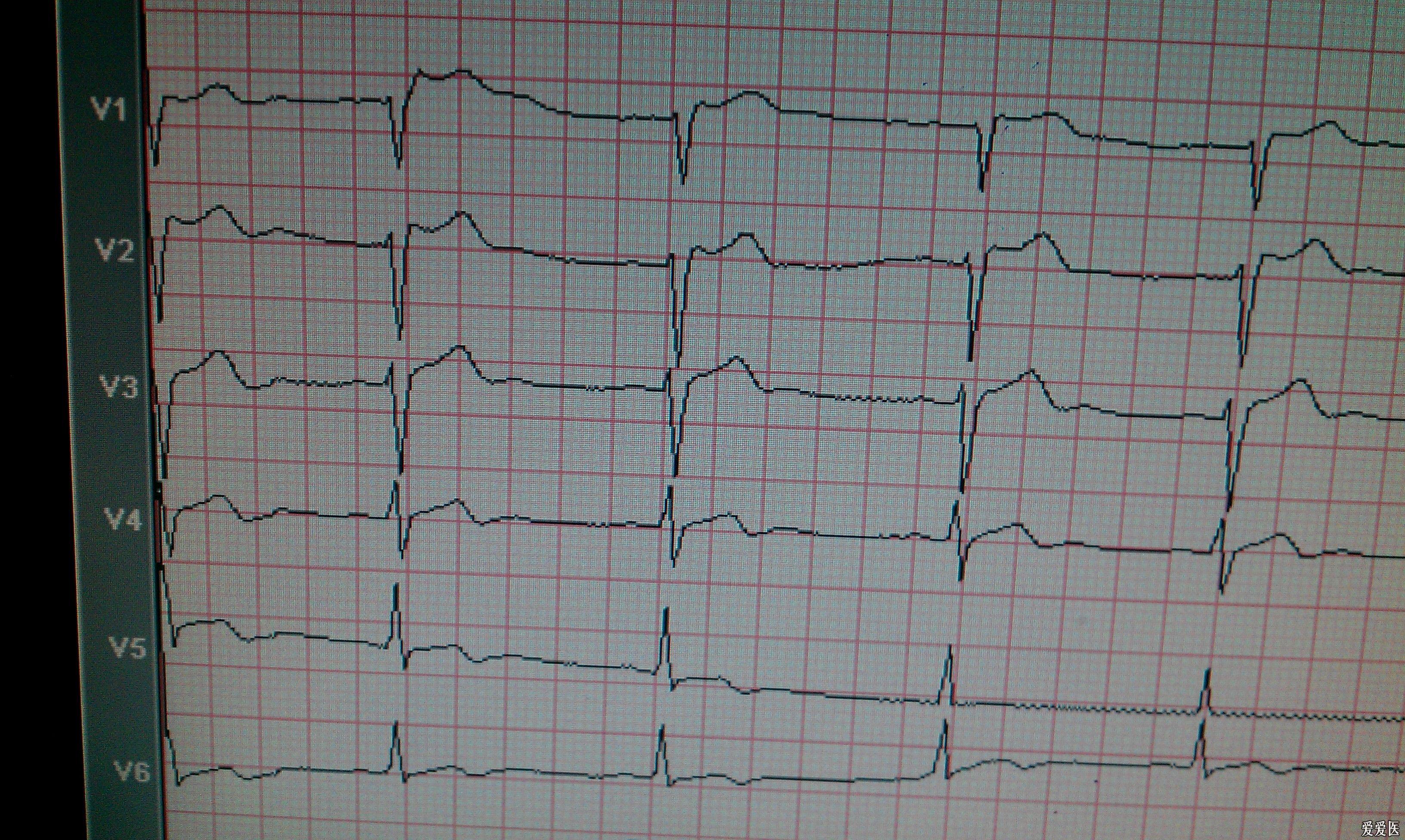 室速or室上速伴室差附複查ecg