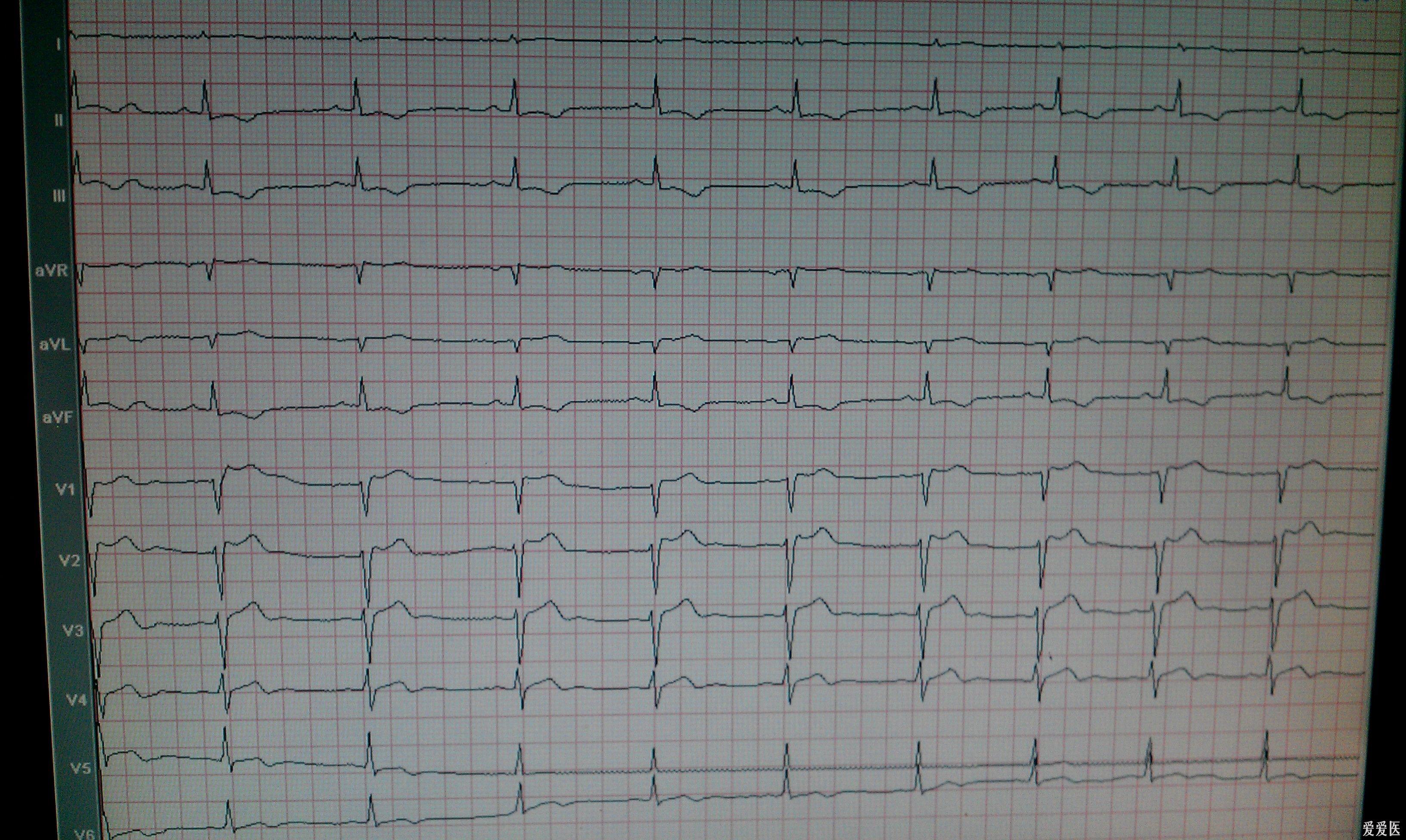 (附複查ecg) - 心電圖腦電圖專業討論版 - 愛愛醫醫學論壇