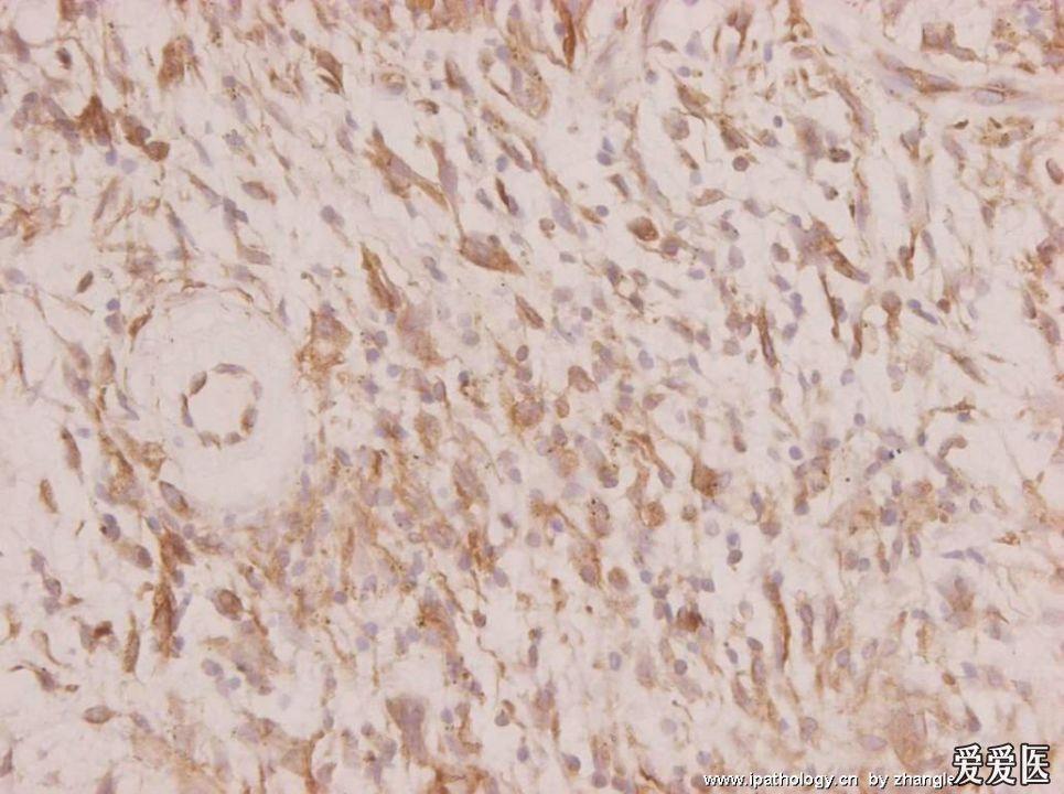 (转)软组织多形性透明变性血管扩张性肿瘤1例