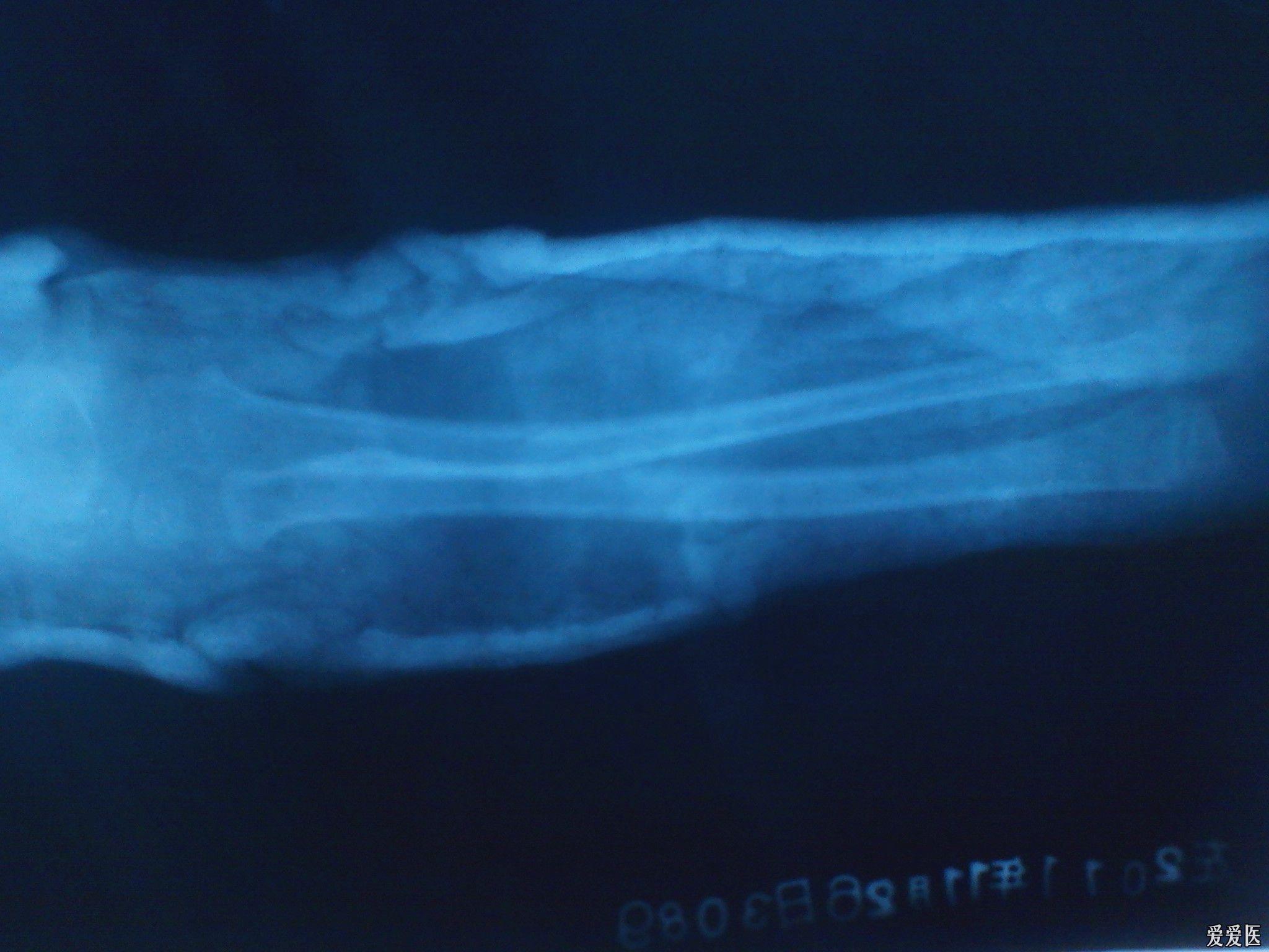 患者尺桡骨近端双折一个星期复查的x光片