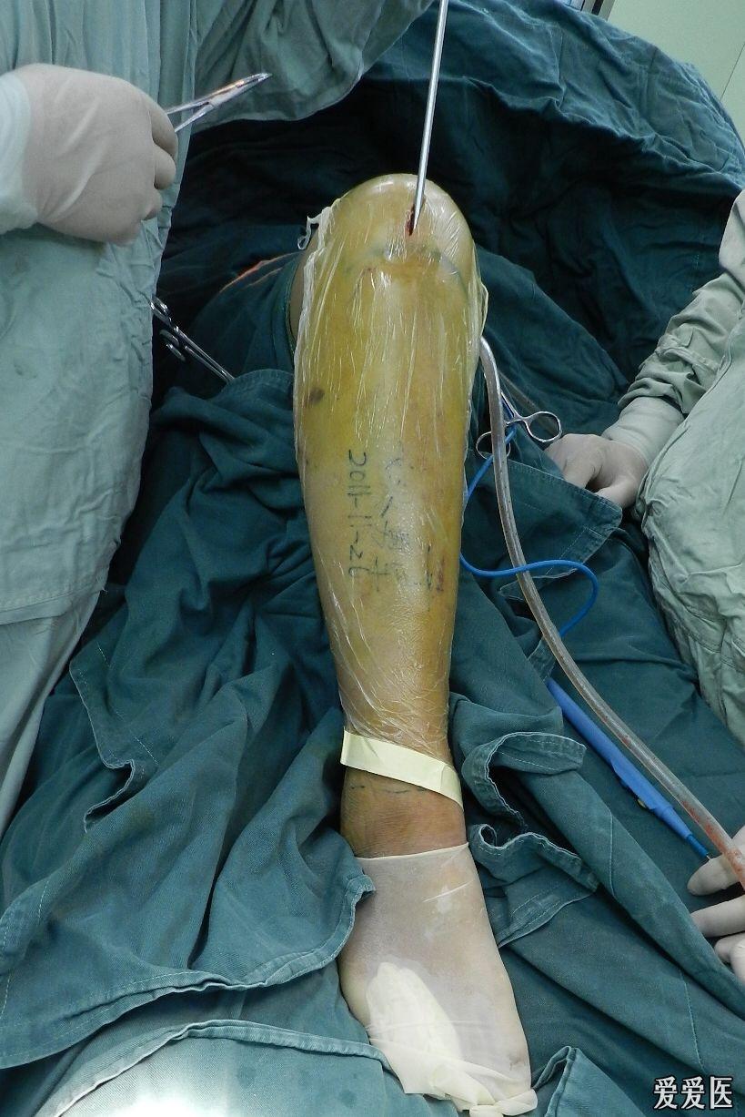 分享历史最微创的胫骨髓内钉置入术认同的赞一个不认同的多多指教