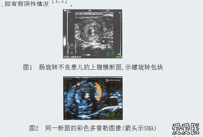 肠旋转不良 - 超声医学讨论版 - 爱爱医医学论坛