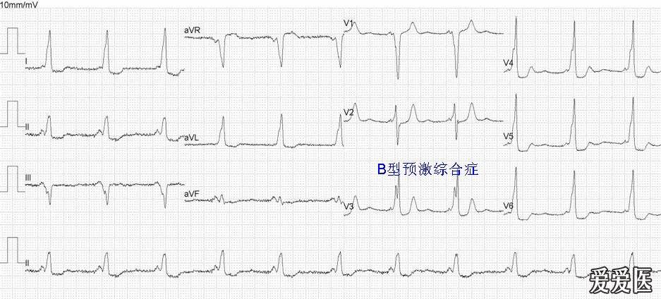 看圖學心電04心律失常總論