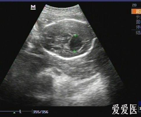 胎儿脑积水