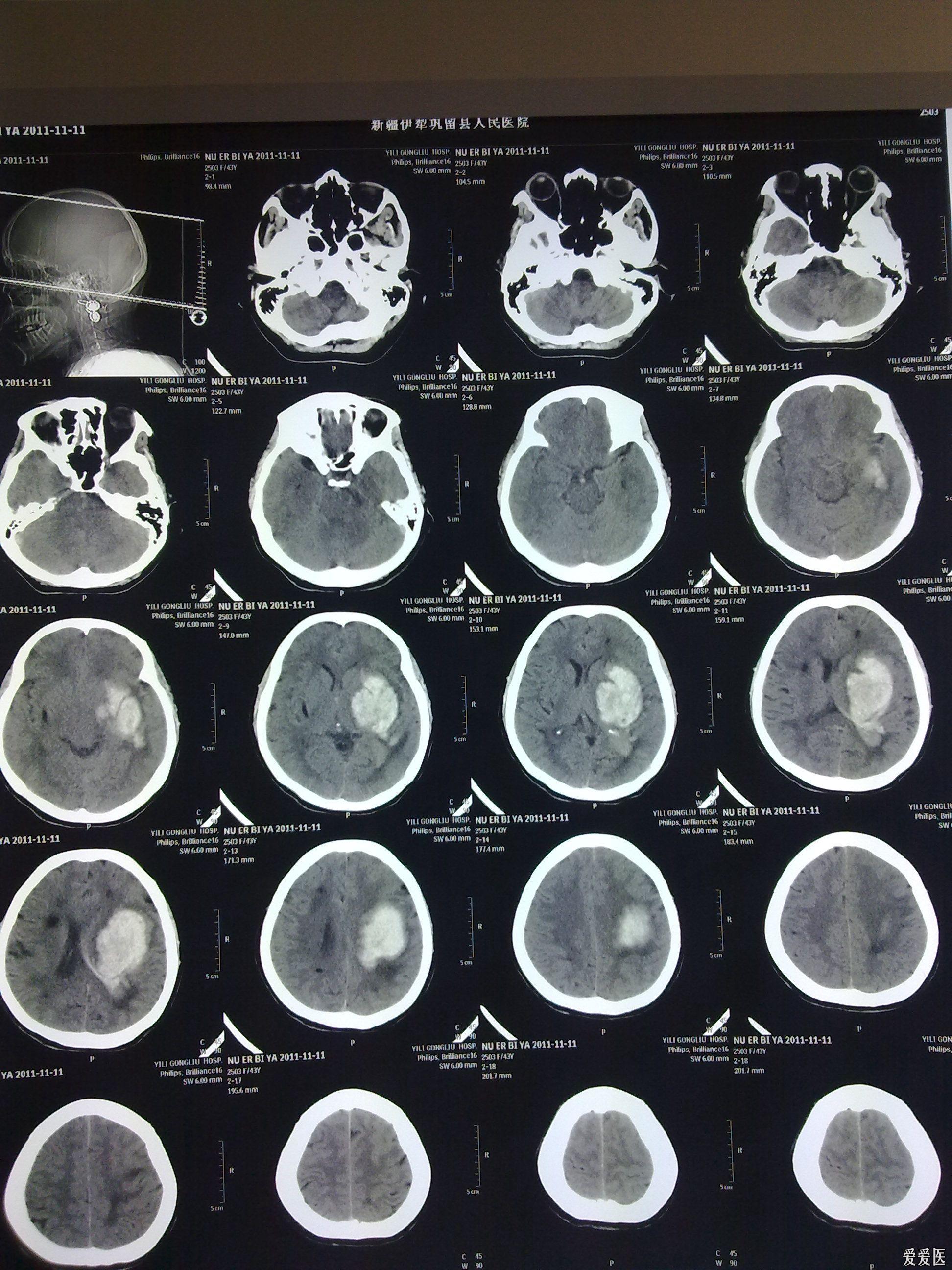 高血压性脑出血3次出血钻孔引流术后